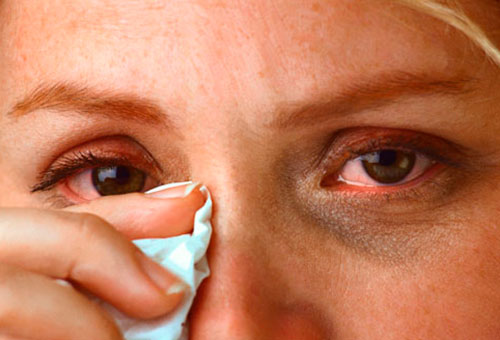 Симптомы воспаления глаз
