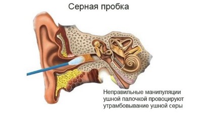 Как почистить в ушах серу