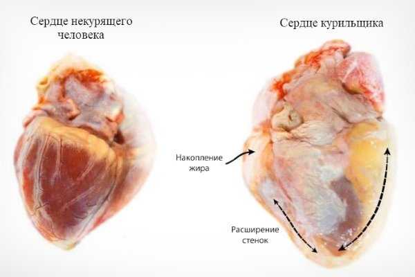 Курение и аритмия сердца