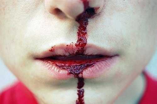 Почему очень часто течет кровь из носа